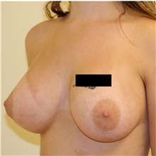 Breast Augmentation After Photo by Steve Laverson, MD, FACS; Rancho Santa Fe, CA - Case 36707