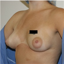 Breast Augmentation Before Photo by Steve Laverson, MD, FACS; Rancho Santa Fe, CA - Case 36707