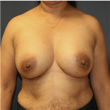 Breast Augmentation After Photo by Steve Laverson, MD, FACS; Rancho Santa Fe, CA - Case 36708