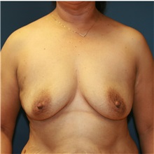 Breast Augmentation Before Photo by Steve Laverson, MD, FACS; Rancho Santa Fe, CA - Case 36708