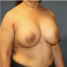 Breast Augmentation After Photo by Steve Laverson, MD, FACS; Rancho Santa Fe, CA - Case 36708