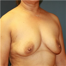 Breast Augmentation Before Photo by Steve Laverson, MD, FACS; Rancho Santa Fe, CA - Case 36708