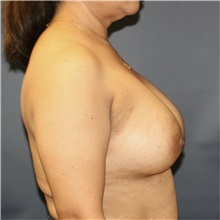 Breast Augmentation After Photo by Steve Laverson, MD, FACS; Rancho Santa Fe, CA - Case 36708