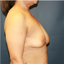 Breast Augmentation Before Photo by Steve Laverson, MD, FACS; Rancho Santa Fe, CA - Case 36708