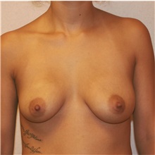 Breast Augmentation Before Photo by Steve Laverson, MD, FACS; Rancho Santa Fe, CA - Case 36711