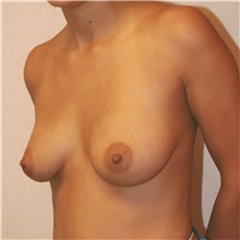 Breast Augmentation Before Photo by Steve Laverson, MD, FACS; Rancho Santa Fe, CA - Case 36711