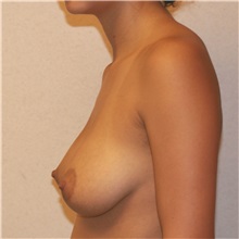 Breast Augmentation Before Photo by Steve Laverson, MD, FACS; Rancho Santa Fe, CA - Case 36711