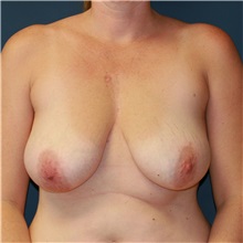 Breast Lift Before Photo by Steve Laverson, MD; San Diego, CA - Case 36713
