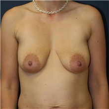 Breast Lift Before Photo by Steve Laverson, MD; San Diego, CA - Case 36714