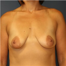 Breast Lift Before Photo by Steve Laverson, MD, FACS; Rancho Santa Fe, CA - Case 36715