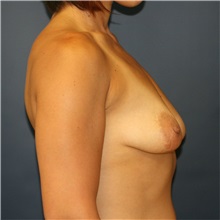 Breast Lift Before Photo by Steve Laverson, MD, FACS; Rancho Santa Fe, CA - Case 36715