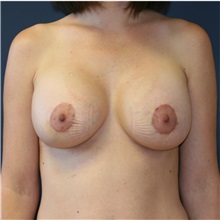Breast Lift After Photo by Steve Laverson, MD, FACS; Rancho Santa Fe, CA - Case 36716