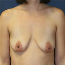 Breast Lift Before Photo by Steve Laverson, MD, FACS; Rancho Santa Fe, CA - Case 36716