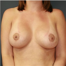 Breast Lift After Photo by Steve Laverson, MD, FACS; Rancho Santa Fe, CA - Case 36717