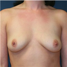 Breast Lift Before Photo by Steve Laverson, MD, FACS; Rancho Santa Fe, CA - Case 36717