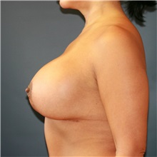 Breast Lift After Photo by Steve Laverson, MD, FACS; Rancho Santa Fe, CA - Case 36725