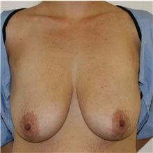Breast Lift Before Photo by Steve Laverson, MD, FACS; Rancho Santa Fe, CA - Case 36726