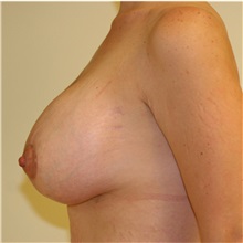Breast Lift After Photo by Steve Laverson, MD, FACS; Rancho Santa Fe, CA - Case 36726