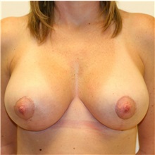 Breast Lift After Photo by Steve Laverson, MD, FACS; Rancho Santa Fe, CA - Case 36728