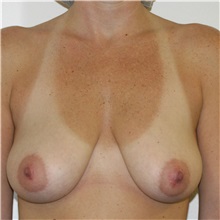 Breast Lift Before Photo by Steve Laverson, MD, FACS; Rancho Santa Fe, CA - Case 36728