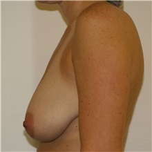 Breast Lift Before Photo by Steve Laverson, MD, FACS; Rancho Santa Fe, CA - Case 36728