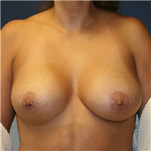 Breast Lift After Photo by Steve Laverson, MD, FACS; Rancho Santa Fe, CA - Case 36729