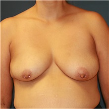 Breast Lift Before Photo by Steve Laverson, MD, FACS; Rancho Santa Fe, CA - Case 36729