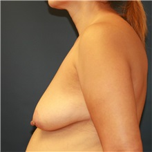 Breast Lift Before Photo by Steve Laverson, MD, FACS; Rancho Santa Fe, CA - Case 36729