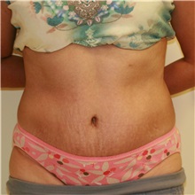 Tummy Tuck After Photo by Steve Laverson, MD, FACS; Rancho Santa Fe, CA - Case 36730