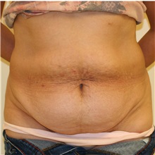 Tummy Tuck Before Photo by Steve Laverson, MD, FACS; Rancho Santa Fe, CA - Case 36730