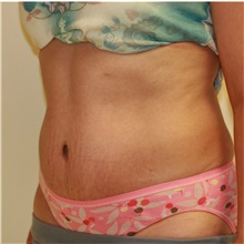 Tummy Tuck After Photo by Steve Laverson, MD, FACS; Rancho Santa Fe, CA - Case 36730