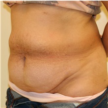 Tummy Tuck Before Photo by Steve Laverson, MD, FACS; Rancho Santa Fe, CA - Case 36730