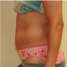 Tummy Tuck After Photo by Steve Laverson, MD, FACS; Rancho Santa Fe, CA - Case 36730