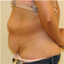 Tummy Tuck Before Photo by Steve Laverson, MD, FACS; Rancho Santa Fe, CA - Case 36730