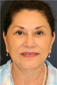 Facelift After Photo by Steve Laverson, MD, FACS; Rancho Santa Fe, CA - Case 36731