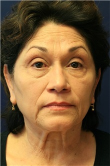 Facelift Before Photo by Steve Laverson, MD, FACS; Rancho Santa Fe, CA - Case 36731