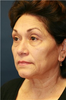 Facelift Before Photo by Steve Laverson, MD, FACS; Rancho Santa Fe, CA - Case 36731