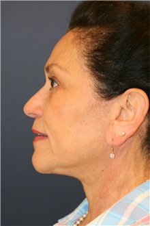 Facelift After Photo by Steve Laverson, MD, FACS; Rancho Santa Fe, CA - Case 36731