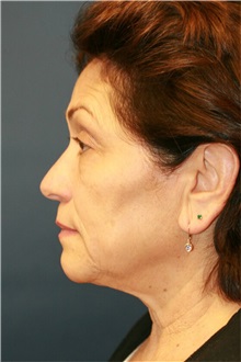 Facelift Before Photo by Steve Laverson, MD, FACS; Rancho Santa Fe, CA - Case 36731