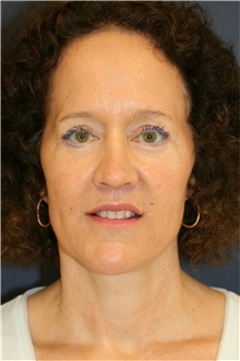 Facelift After Photo by Steve Laverson, MD, FACS; San Diego, CA - Case 36732