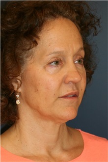 Facelift Before Photo by Steve Laverson, MD, FACS; San Diego, CA - Case 36732