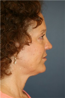 Facelift Before Photo by Steve Laverson, MD, FACS; San Diego, CA - Case 36732