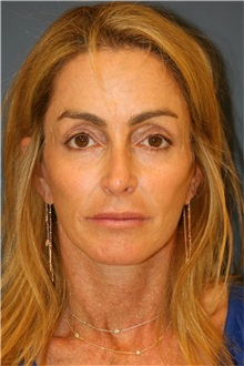 Facelift After Photo by Steve Laverson, MD, FACS; San Diego, CA - Case 36733