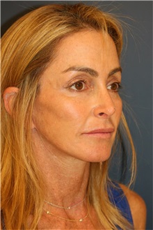 Facelift After Photo by Steve Laverson, MD, FACS; San Diego, CA - Case 36733