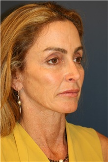 Facelift Before Photo by Steve Laverson, MD, FACS; San Diego, CA - Case 36733