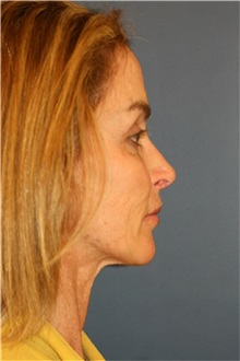 Facelift Before Photo by Steve Laverson, MD, FACS; San Diego, CA - Case 36733