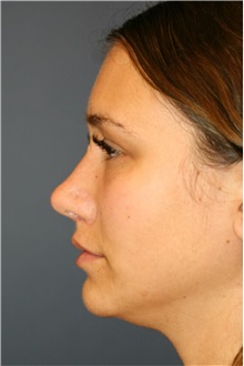 Rhinoplasty After Photo by Steve Laverson, MD, FACS; Rancho Santa Fe, CA - Case 36734