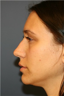 Rhinoplasty Before Photo by Steve Laverson, MD, FACS; Rancho Santa Fe, CA - Case 36734