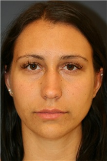 Rhinoplasty Before Photo by Steve Laverson, MD, FACS; Rancho Santa Fe, CA - Case 36734