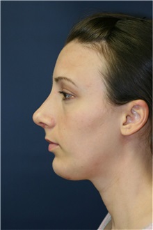 Rhinoplasty After Photo by Steve Laverson, MD, FACS; Rancho Santa Fe, CA - Case 36735